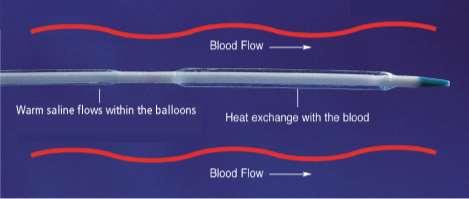 Cool or warm saline flows within the balloons Blood is cooled or warmed as