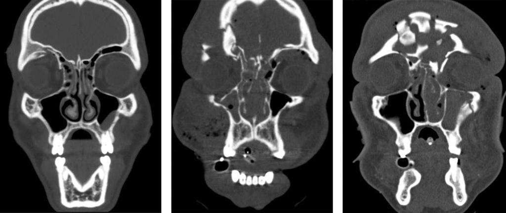 Furlow CE facial fractures are significantly more likely to experience traumatic brain injury, skull base fractures, cranial vault fractures, cervical spinal fractures, eye injuries, and facial