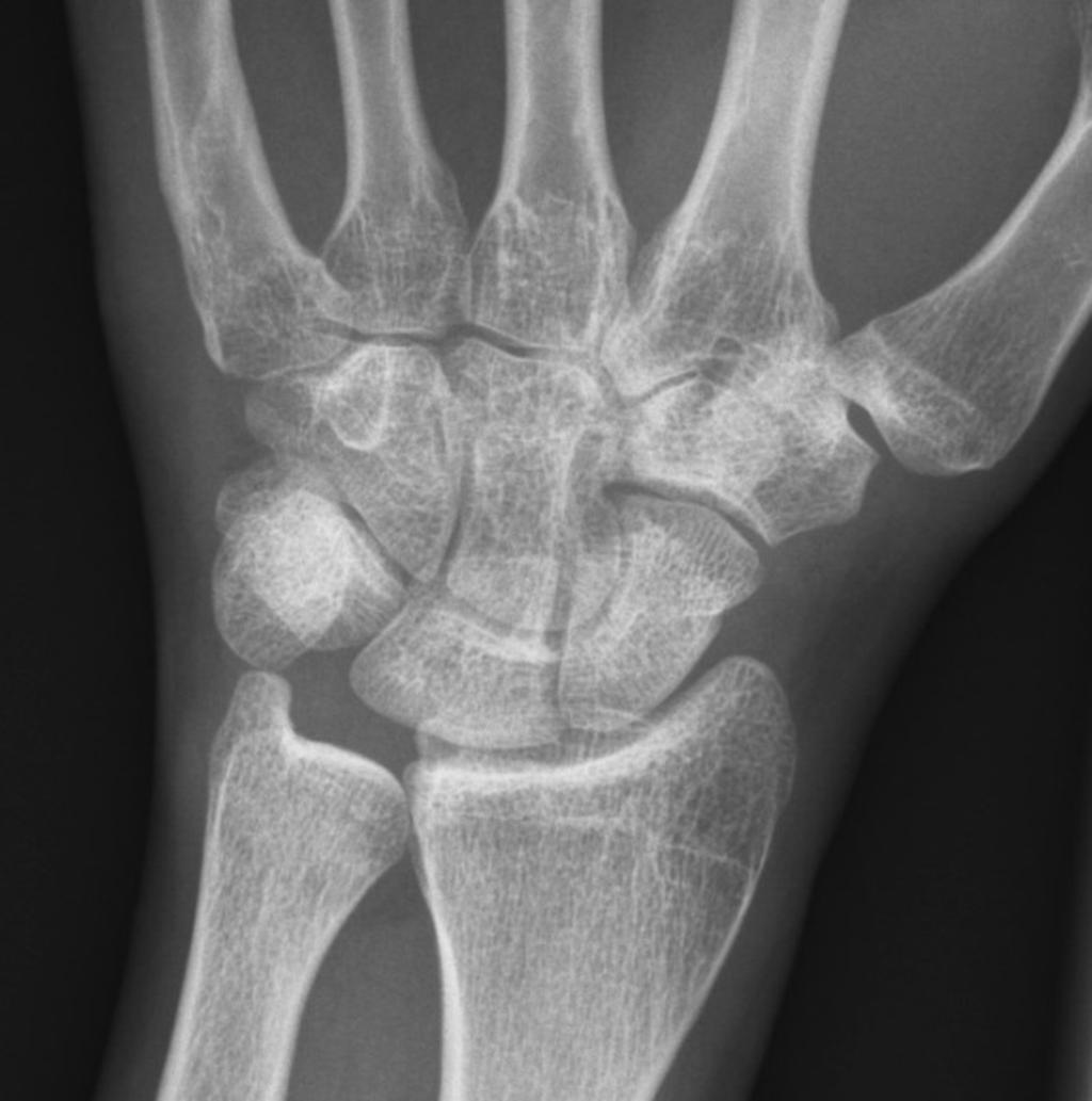 The same holds true in 27 out of 30 cases where radiographs were equivocal in whom CBCT could exclude a wrist fracture (i.e. in 90 %).