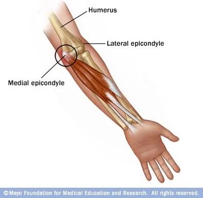 Golfers elbow Golfers elbow is a condition in which the tendons that attach your flexor muscles to the medial epicondyle become damaged.