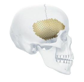 MatrixNEURO MatrixNEURO Preformed (Temporal, Frontal, FTP, Universal) Mesh Plates Temporal The Temporal implant is designed for reconstructions of Temporal defects.