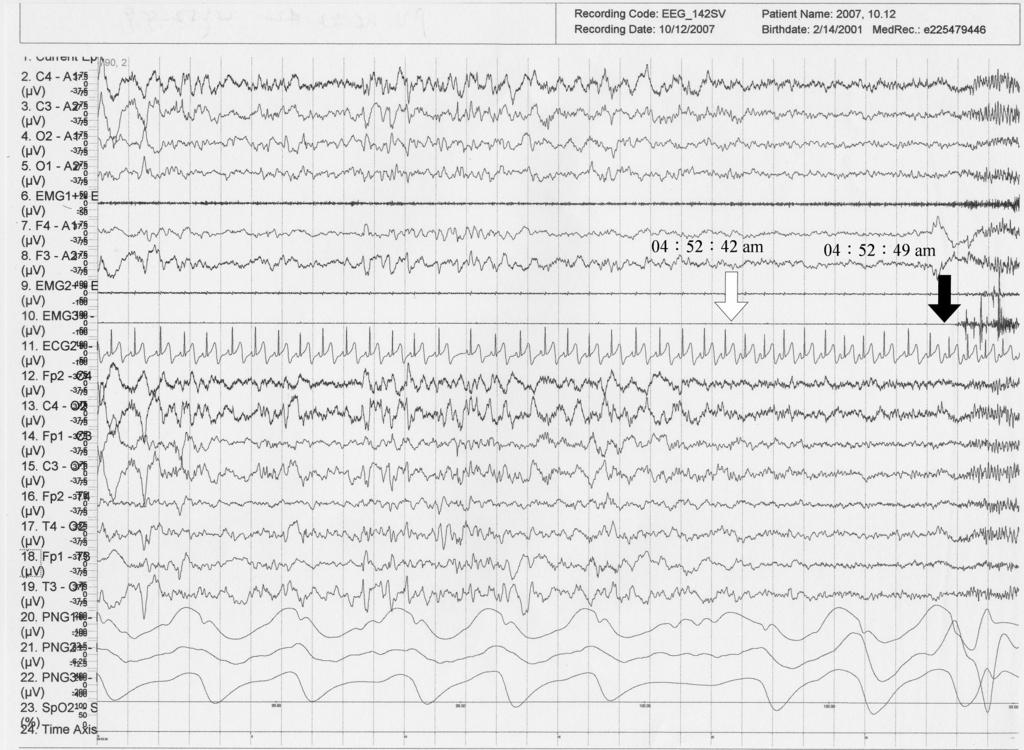 283 fourth and f ifth seizures; fourth REM sleep period occurred after the sixth seizure.
