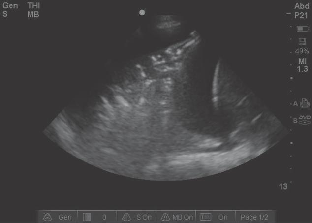 ultrasonographic pattern of alveolar consolidation. In large effusions, the compressed airless lung floats with dynamic movement within the effusion.