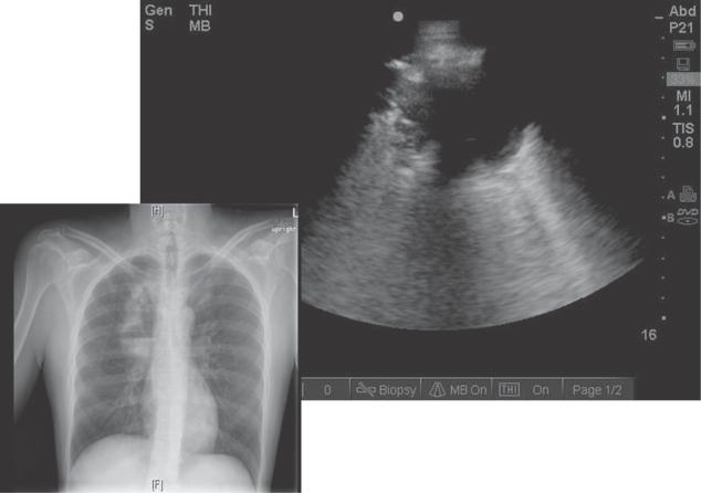 Figure 7. Lung mass. A, Ultrasonograph image of lung mass. Longitudinal scan, anterior right chest. Notice irregular borders with hypoechoic interior. B, Chest radiograph. C, Chest CT scan.