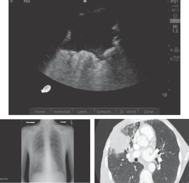 Loculated pleural effusions may occur any place in the thorax and require targeted ultrasound scanning.