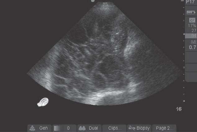 Figure 9. Small pleural effusion with atelectasis and comet-tail artifact. Longitudinal scan midaxillary line on right. There is a small pleural effusion with atelectatic lung.