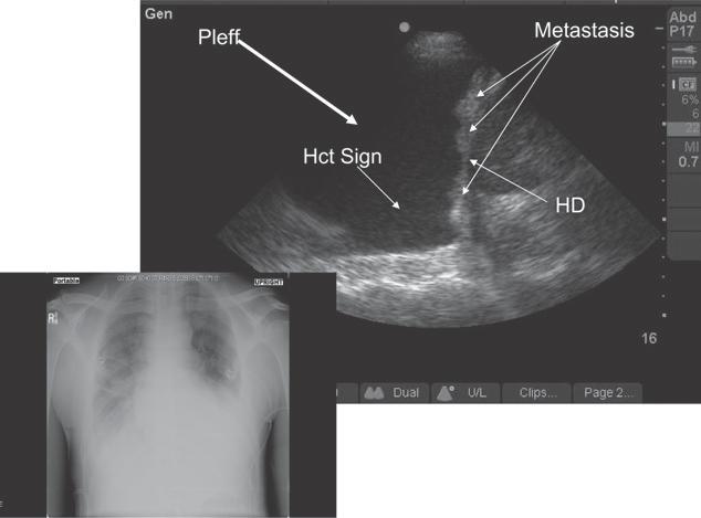 Figure 11. Simple anechoic pleural effusion. Longitudinal scan midaxillary line on left. Notice anechoic appearance of pleural effusion with atelectatic lung floating within it.