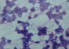 literature (12). Cytologically, a diagnosis of Ewing s sarcoma was made and confirmed microscopically. PAS stain was positive in 4 cases (Fig.5,6,7).