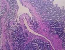 neuroblastoma secondaries or an Ewing s sarcoma.