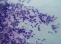 Fig-8; Ependymoma; Squash cytology Fig-9; Ependymoma; HPE One more case of Medulloblastoma diagnosed on squash cytology was also confirmed on HPE.