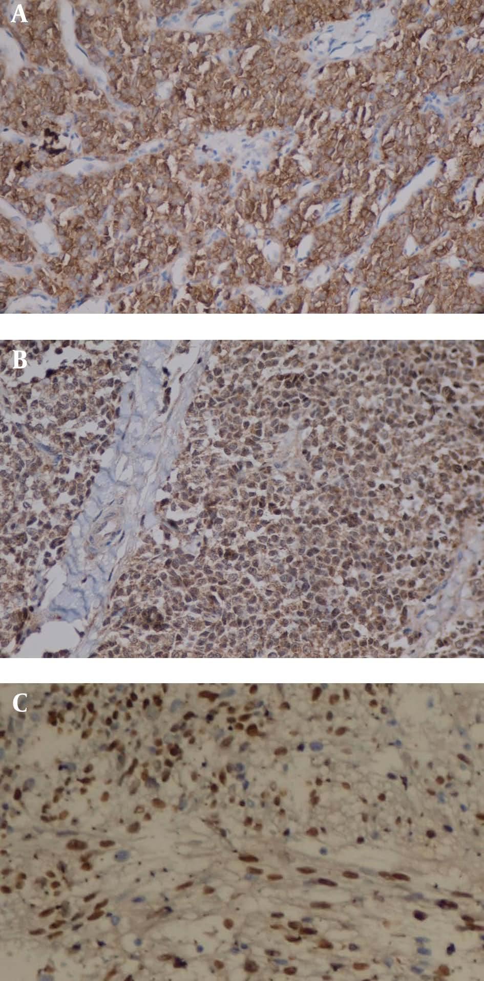 4.3. Immunohistochemical Analysis The IHC staining results for sinonasal tumors are presented in Table 2 and patterns of expression were shown in Figure 2 A-C Figure 2.