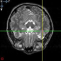 Figure 5: Dipole location results on a patient s MRI. The dipole appears in a Left Temporal area, matching the results obtained with other techniques.