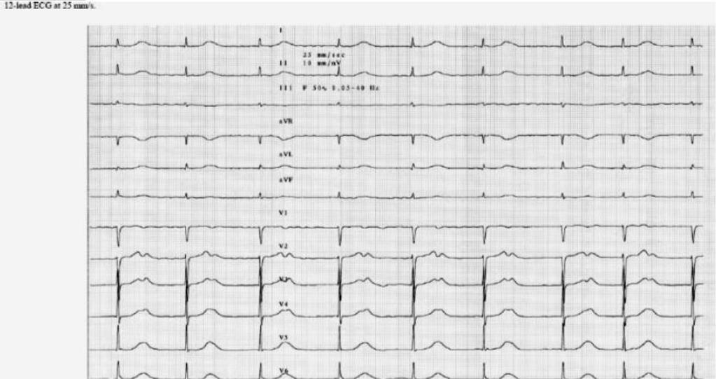 11.- This tracing was recorded at the emergency room in an 85 year old man with aortic stenosis (valvular area 1.1 cm²). What is your diagnosis? a.- Extreme first degree AV block with sinus arrhythmia b.