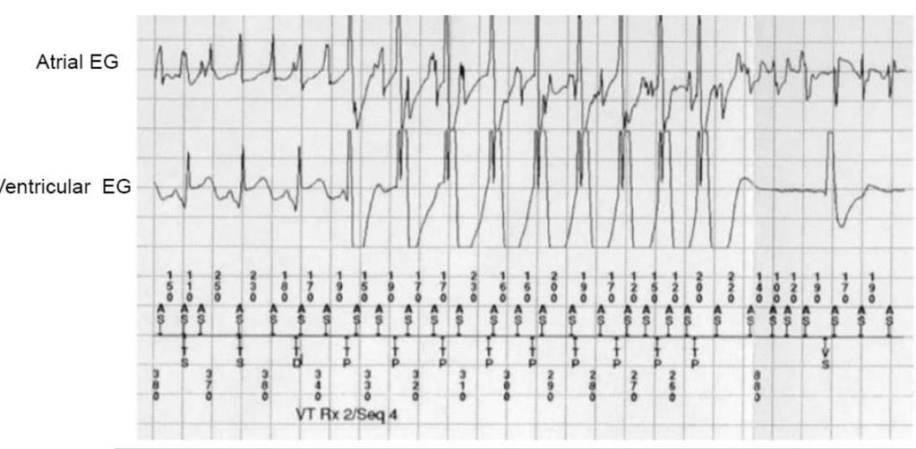 7.- Stored electrograms of an ICD recorded during antitachycardia pacing. The most likely diagnosis is : a.