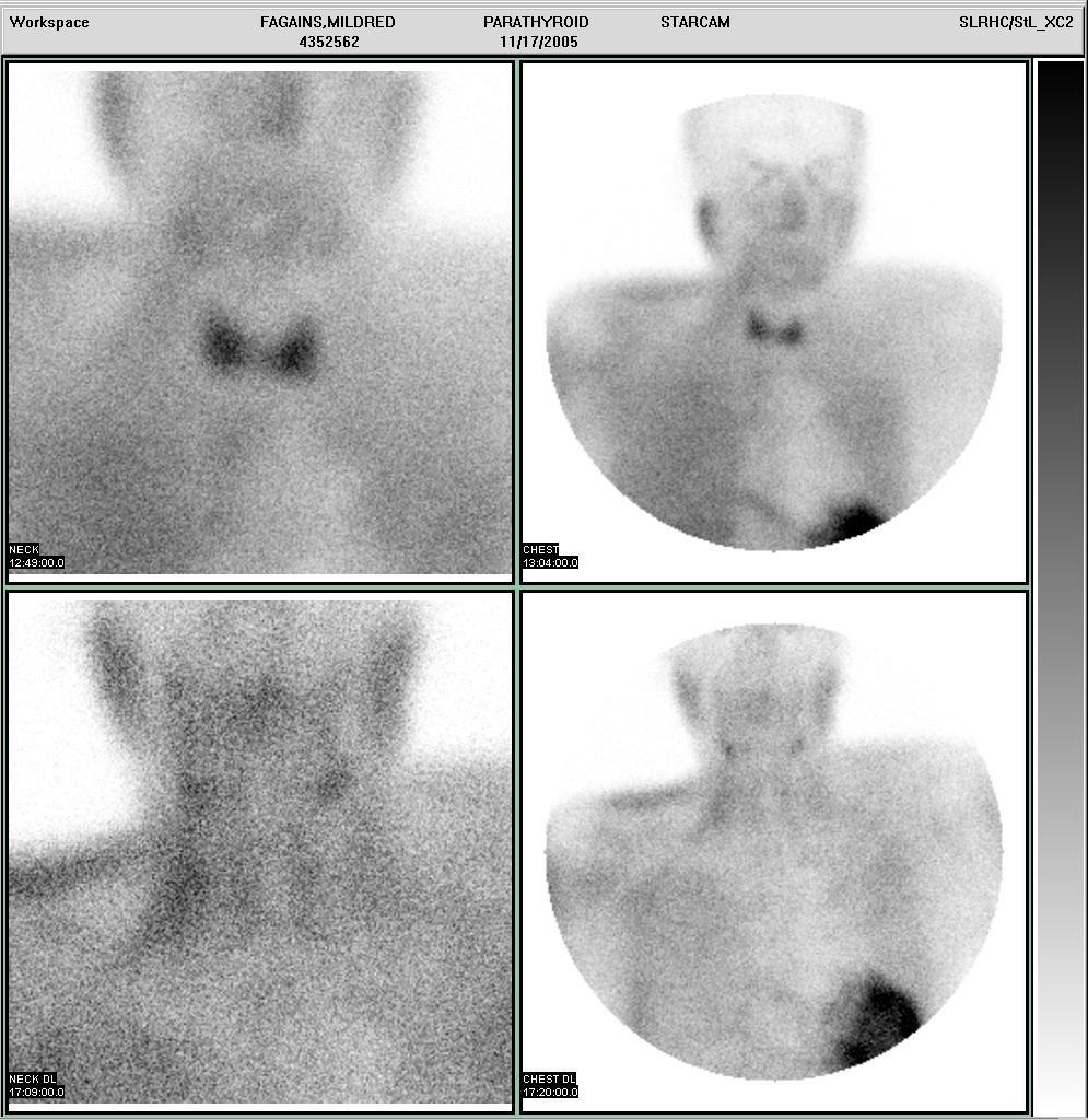 Parathyroid scan: Immediate (10-15min) and delayed (2hr) images of the neck and chest are acquired after intravenous administration of 25 mci of Tc99mMIBI.