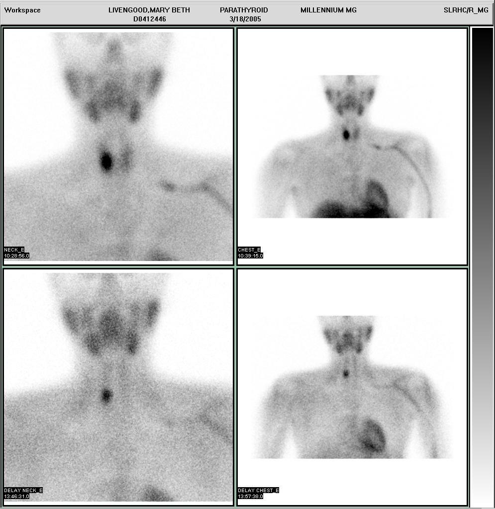 Persistant focal activity at the inferior pole of the right lobe of thyroid, consistent with parathyroid