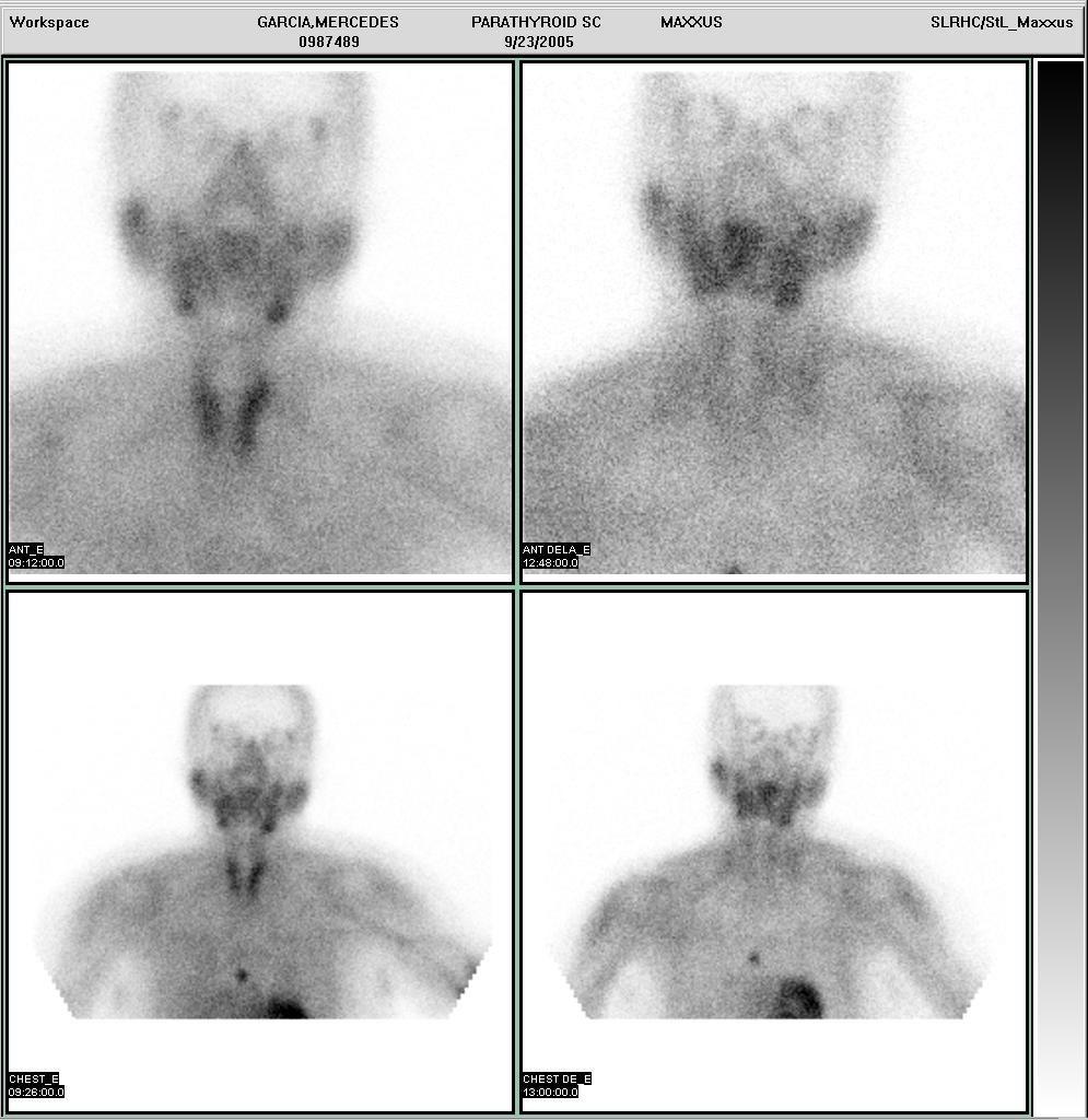Persistant focal activity in the mediastinum, consistent with an ectopic parathyroid adenoma.