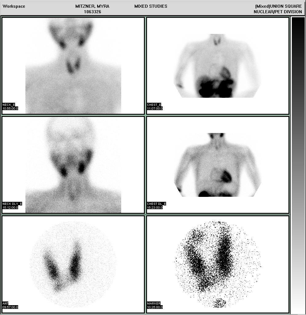 The parathyroid scan shows mild persistant focal activity at the inferior pole of the right lobe of thyroid.