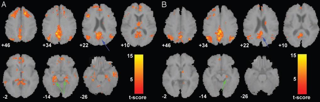 The DMN and Self-Referential Processes in Alzheimer Disease Healthy Elderly Subjects AD Subjects The AD group showed decreased resting-state activity in the posterior