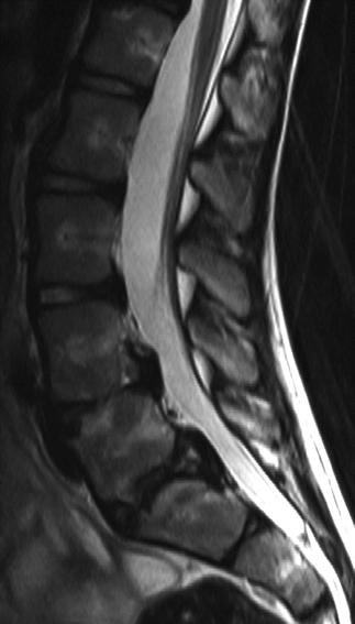 Disc herniation in children Repeated