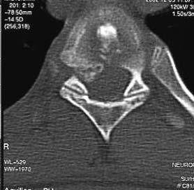Disc space calcification Typically involves the