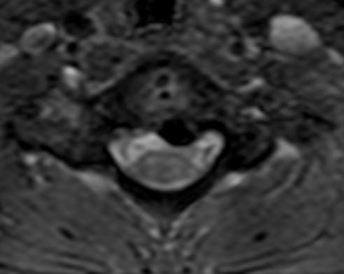 complaint: local pain Herniation of calcified disc