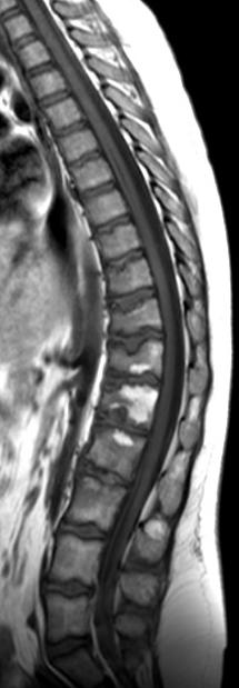 on three adjacent vertebral bodies, end-plate changes, disk-space narrowing Onset occurs in