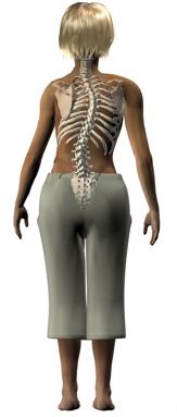 6) Painful scoliosis Pain occurring with recent-onset scoliosis: consider tumor or HSM Controversial association between idiopathic scoliosis and pain: General belief that idiopathic scoliosis does