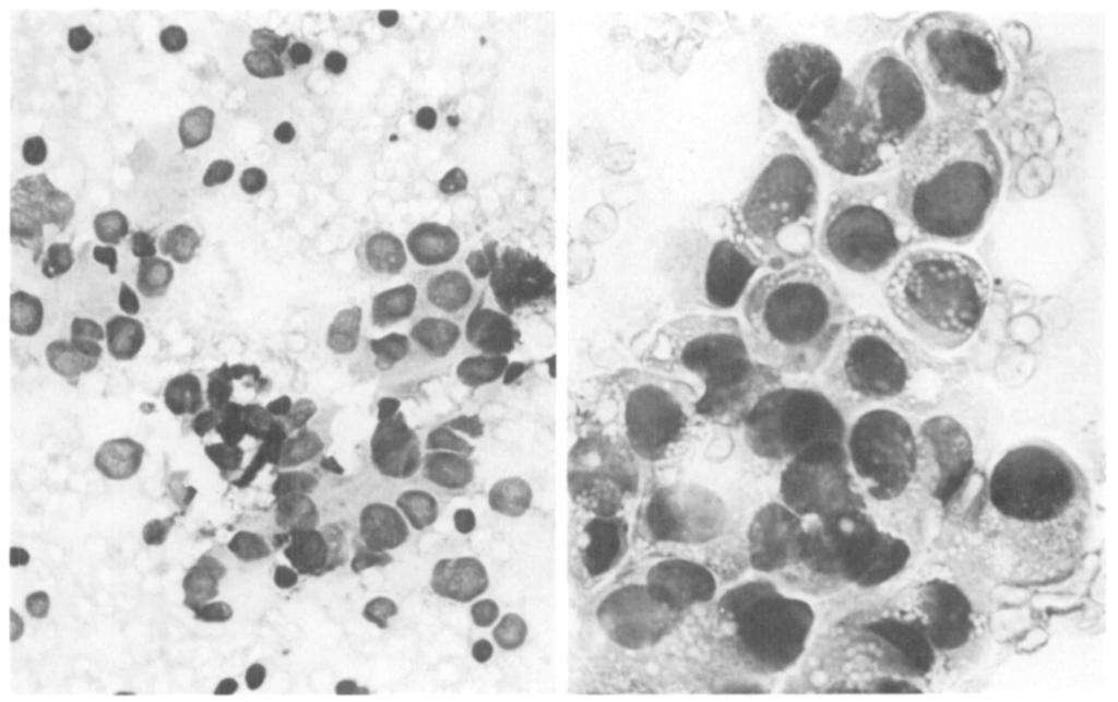 Note the intracytoplasmic granules and vacules. Hematoxylin and eosin. x40. node aspiration biopsies from four anatomic locations in males and females of ages 0 to over 80 years.