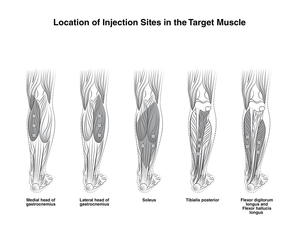 Tble 4: Dosing by Muscle for Lower Limb Spsticity Occipitlisb 30 Units divided in 6 sites Temporlisb 40 Units divided in 8 sites Muscle Trpeziusb 30 Units divided in 6 sites Gstrocnemius medil hed 75