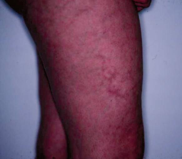 Picture 1 Picture 2 Livedo reticularis (picture 1) and coronary artery thrombosis (picture 2) as examples for manifestations in APS Clinically evaluated with a large serum panel Antiphospholipid