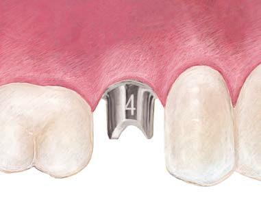 For Certain Internal Connections: Activate the fingers on the BellaTek Abutment using the QuickSeat Activator Tool.