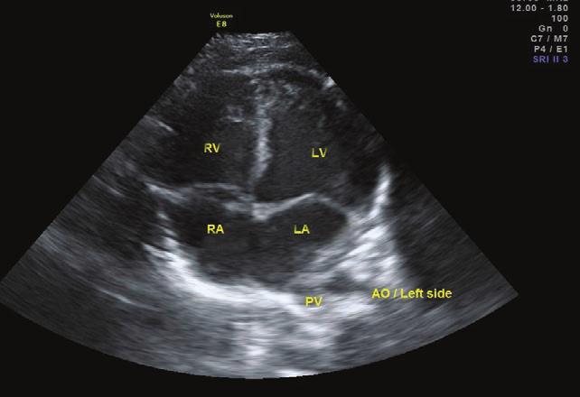 Pulmonary valve regurgitation at 37 hbd The condition of the neonate improved after oxygen therapy, there were no overt signs of cardio-respiratory insufficiency.