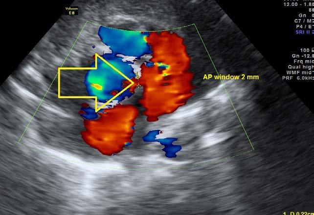 The APW of 2,2 mm was still present above the level of arterial valves (Fig. 6).