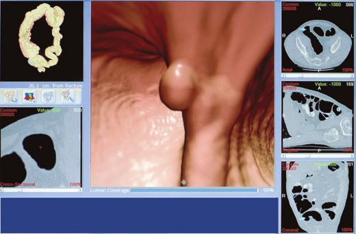 from rectum to caecum and back. The primary 3D virtual reality colonic fly-through is co-registered with the conventional 2D CTC image, which is instantly accessible from the same screen (Figure 2).