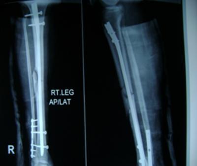 Serial X-rays of a patient with unreamed locked nail Figure 3 (a) Pre-operative x-ray