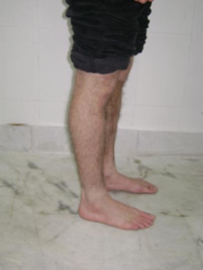 Figure 8 a) Post operative photograph of same patient treated by unreamed AO locked nailing showing full knee extension {image:9} DISCUSSION Locked nailing has been accepted by trauma surgeons as the