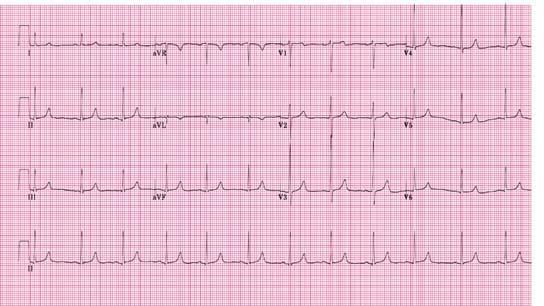 Mirror Test True Posterior Leads Acute Anterior MI S T elevation, and T wave inversion in leads I, V2, V3, and V4 Reciprical ST depression in leads III and