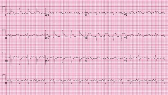 Triangle pointing up indicates RBBB. Triangle pointing down indicates LBBB.