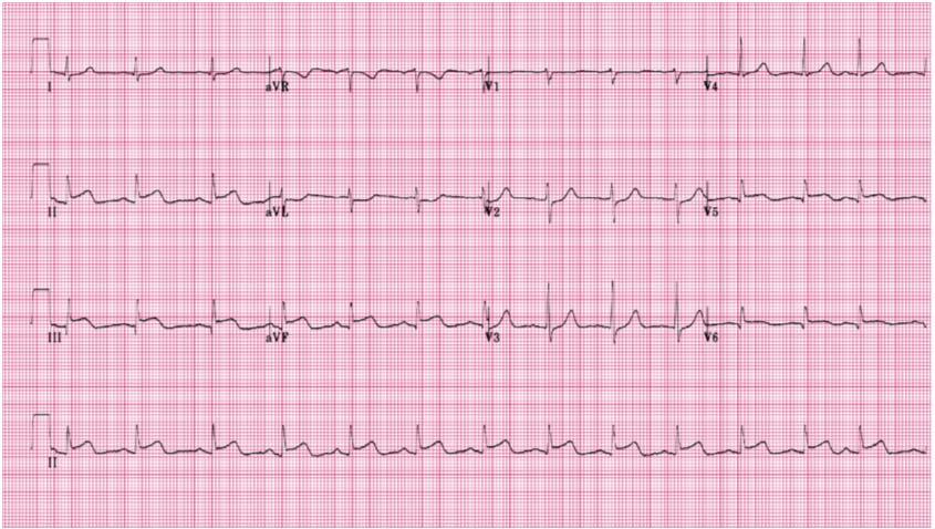 Practice 3 Practice 3 ST Elevation in leads II, III, and avf (Inferior) Reciprocal ST Depression in V2 and avl What is the interpretation?