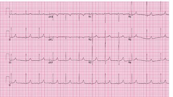 The Normal 12 Lead (2 of 2) Another Standard Layout 25 26 Interpretation of 12 Lead EKGs 5 + 3