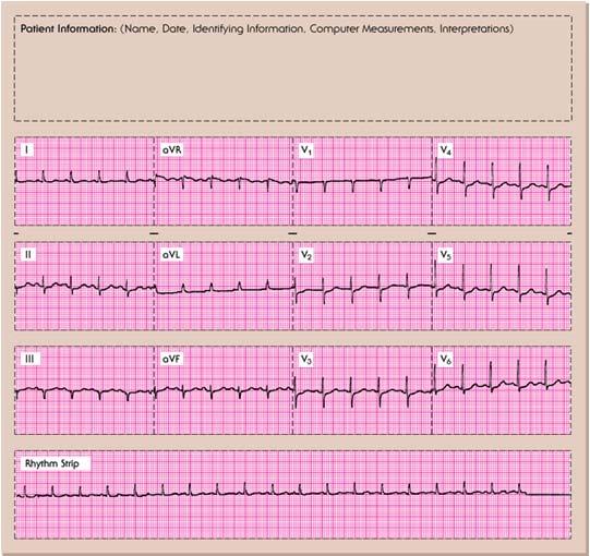 EKGs +3 ST Depression Present? In which leads? Reciprocal? ST Elevation Present? In which leads? Is there reciprocal ST depression present?