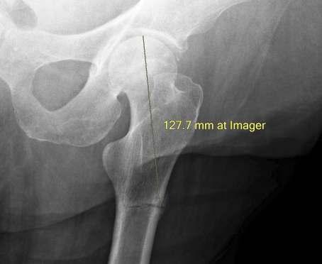 In fact the plain film does show a break in the cortex of the lateral femoral shaft below the lesser trochanter which is measurable on a high-resolution image as 115.