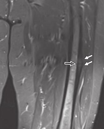fractures in 57-year-old asymptomatic woman taking