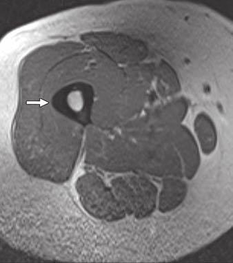 (G), and coronal STIR (H) images of right femur show focal