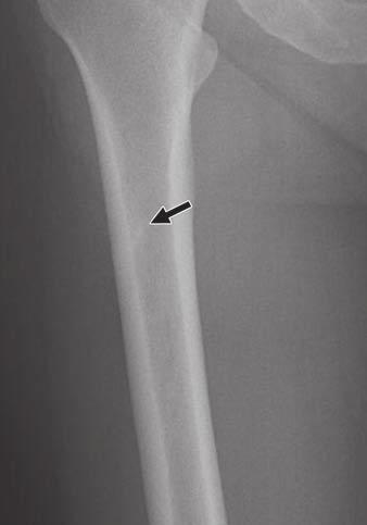 Femoral Fractures in Asymptomatic Patients Fig. 2 Right incomplete subtrochanteric femoral fracture in asymptomatic 50-year-old active woman taking alendronate therapy for 8 years.