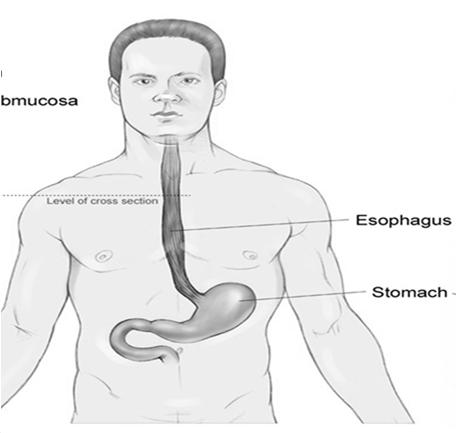 BARRETT S ESOPHAGUS Repeated exposure to acidic stomach contents washing back (refluxing) through the lower esophageal sphincter may cause squamous cells to be replaced by glandular cells resembling