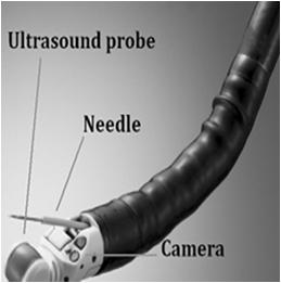 ENDOSCOPY Staging-Endoscopic Ultrasound (EUS) Determine the depth of tumor invasion (T) Mediastinal and perigastric lymph nodes are readily seen and biopsied by EUS (N) Signs of distant spread may be