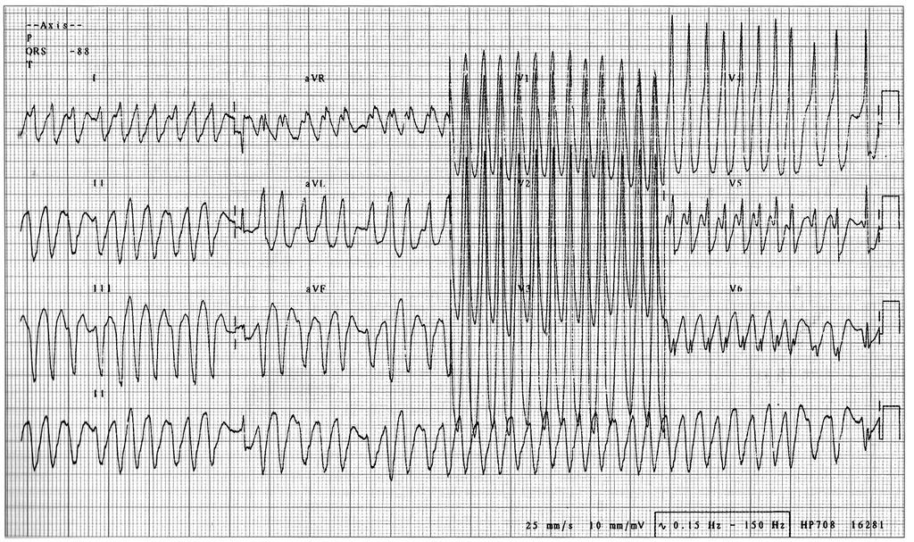 Sustained tachycardia with wide QRS Courtesy from Prof. Antonio Américo Friedmann. Electrocardiology Service of University of Faculty of São Paulo.