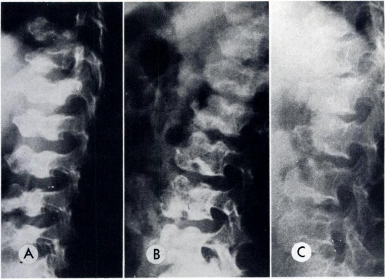 DYG GVE-M ELCH IOR-CLAUSEN SYNDRO ME 109 TABLE 1 Radiologic Findings in DMC Syndrome Spine Pelvis and Hip Joints Generalized platyspondyly Os ilium crest with semi- Double vertebral hump with lunar